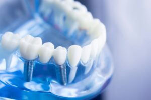 Jak wybrać implanty dentystyczne?