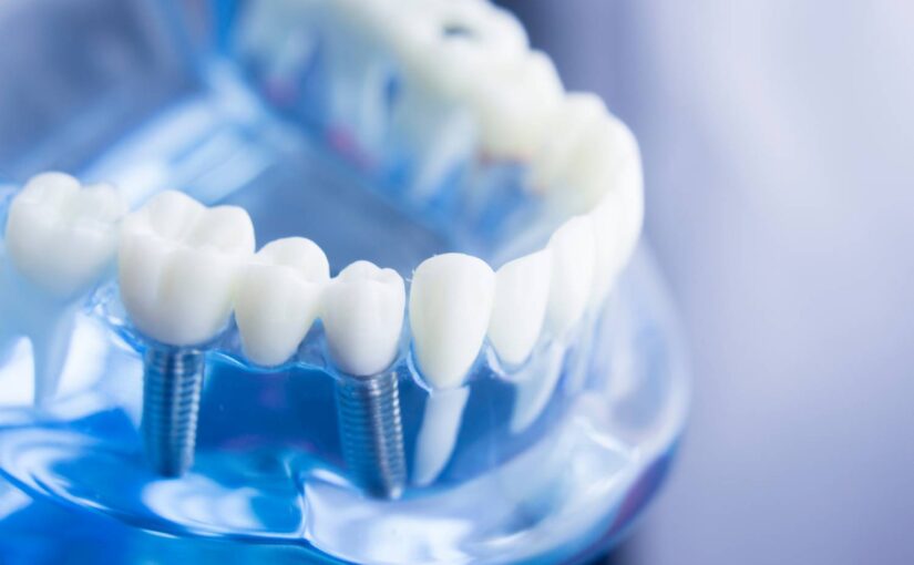 Jak wybrać implanty dentystyczne?